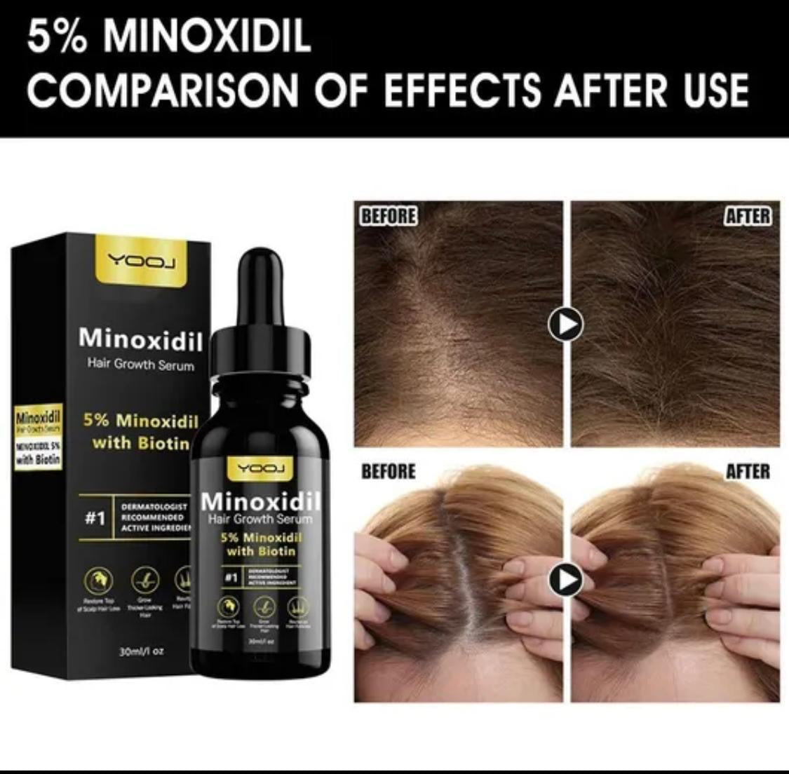 Minoxidil 5% hair serum